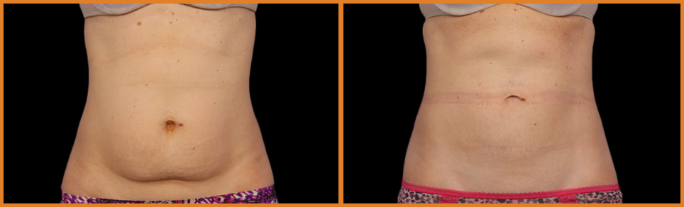 Before and after body transformation images