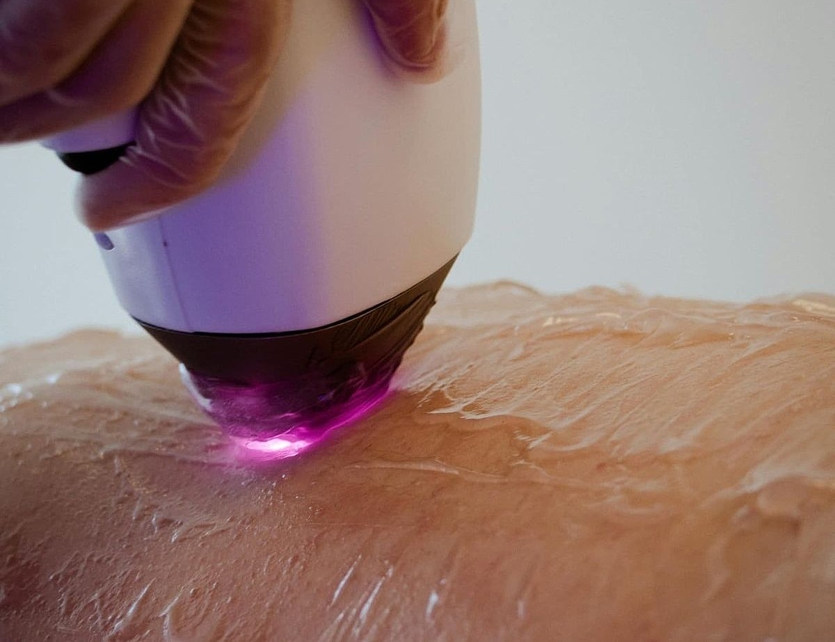 Laser treatment on skin with glowing device.